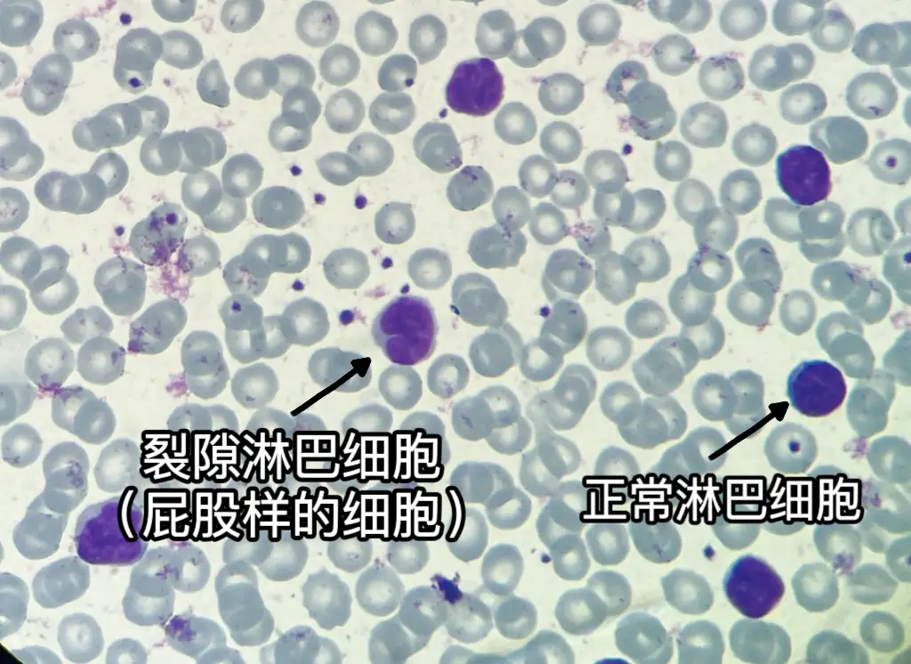 7岁女孩持续咳嗽一个月，血常规发现异常细胞，医生揭示病因