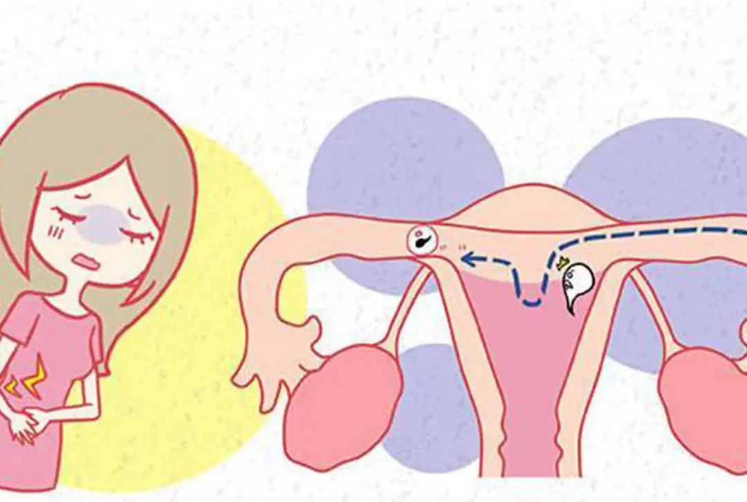 子宫腺肌症与怀孕：揭秘常见误区及真相  第1张