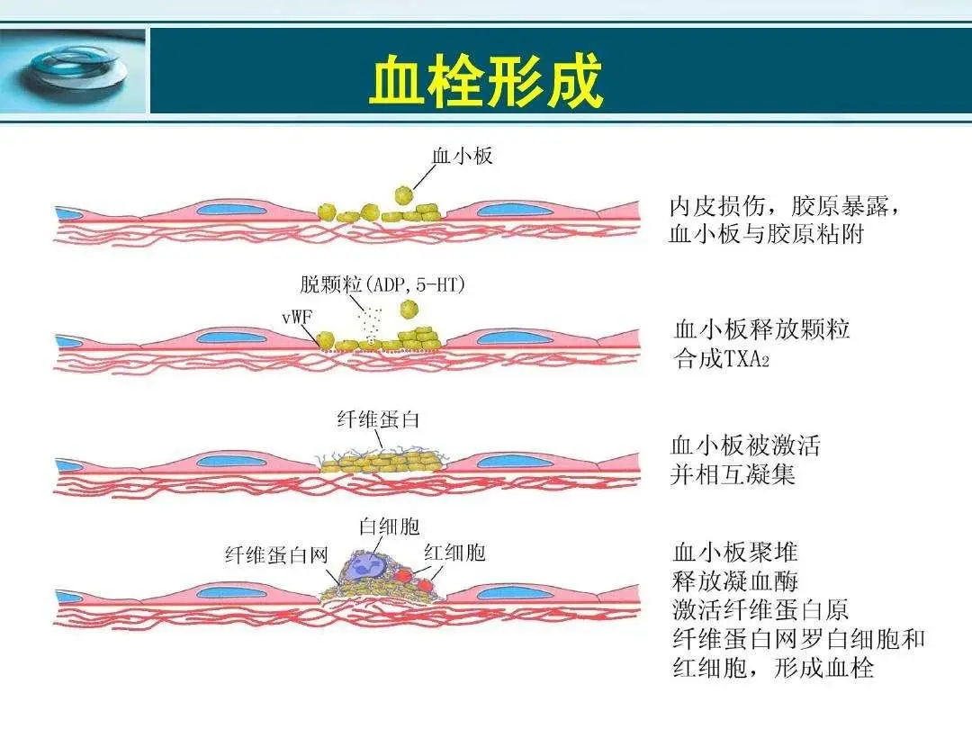 深入了解血栓：静脉血栓与动脉血栓的危害及预防措施  第2张