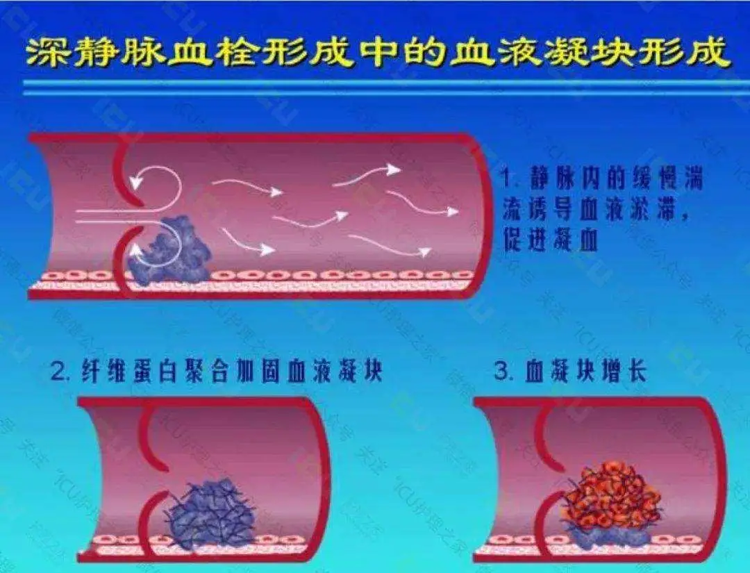 深入了解血栓：静脉血栓与动脉血栓的危害及预防措施  第3张