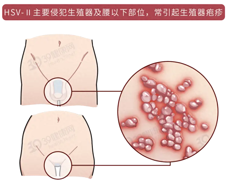 性生活前如何判断对方是否患有性病？了解6类常见性病的症状表现  第5张