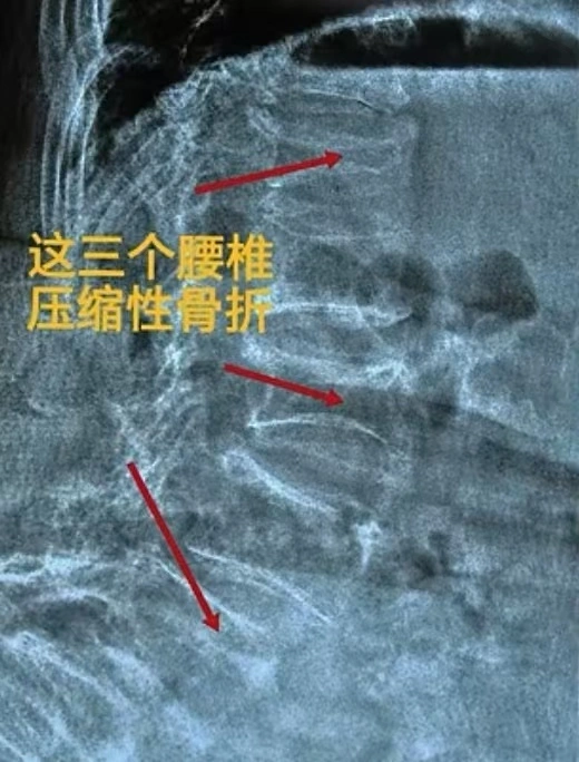 深入剖析骨质疏松症常见误区：正确认识与科学防治  第4张