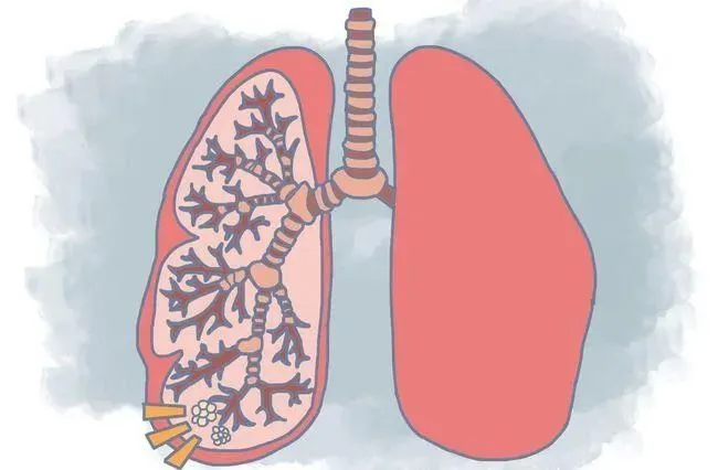 肺结节是什么？了解肺结节的类型及其对健康的影响  第5张