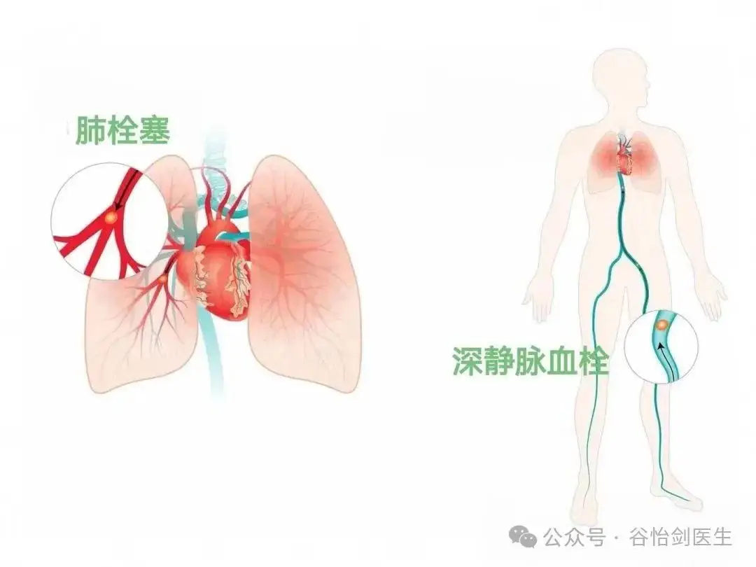 长时间驾驶与静脉健康：出租车及网约车司机需警惕静脉曲张风险  第6张