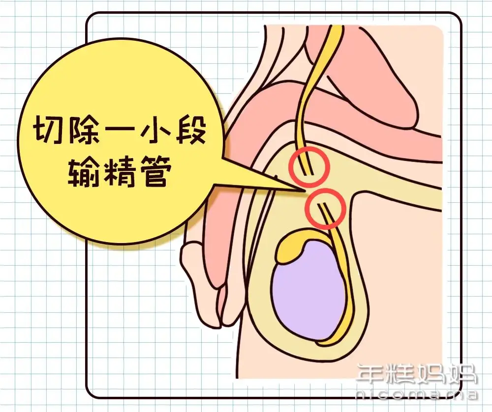 男性避孕方式科普：揭秘男性在避孕中的责任与选择  第3张