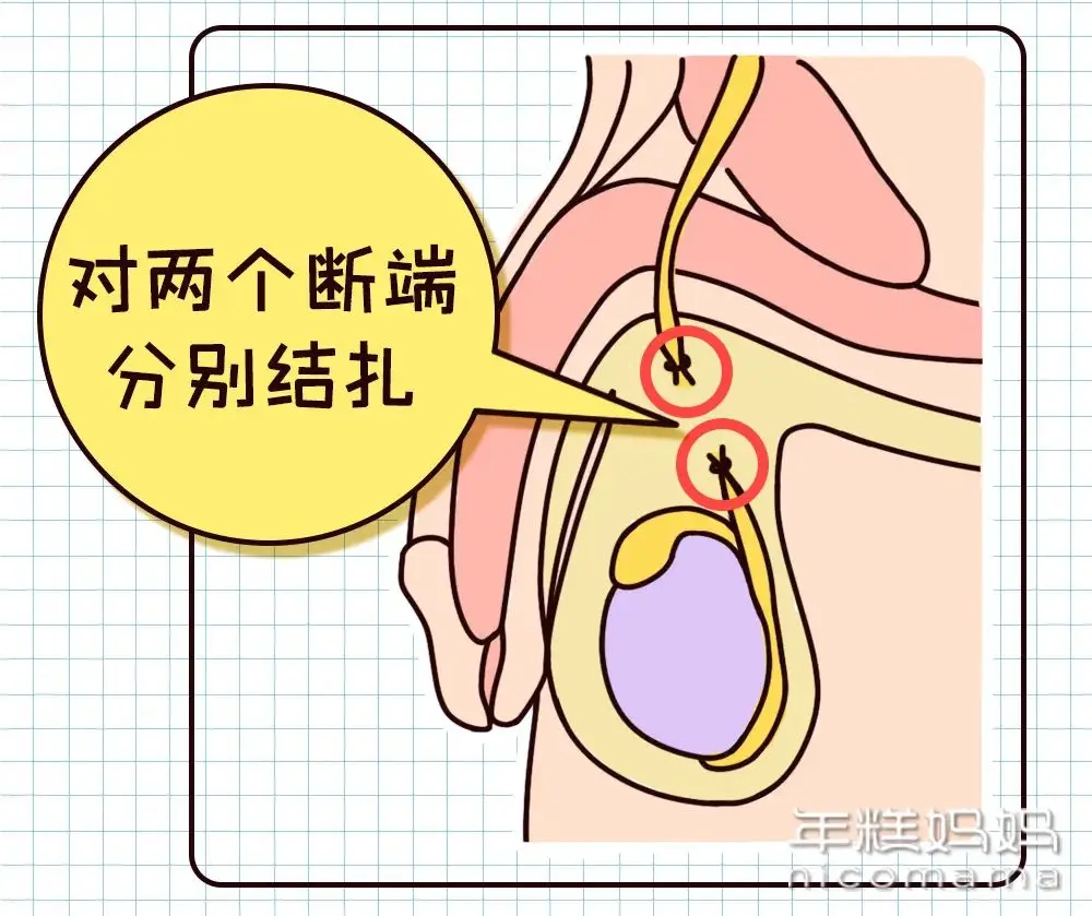 男性避孕方式科普：揭秘男性在避孕中的责任与选择  第4张