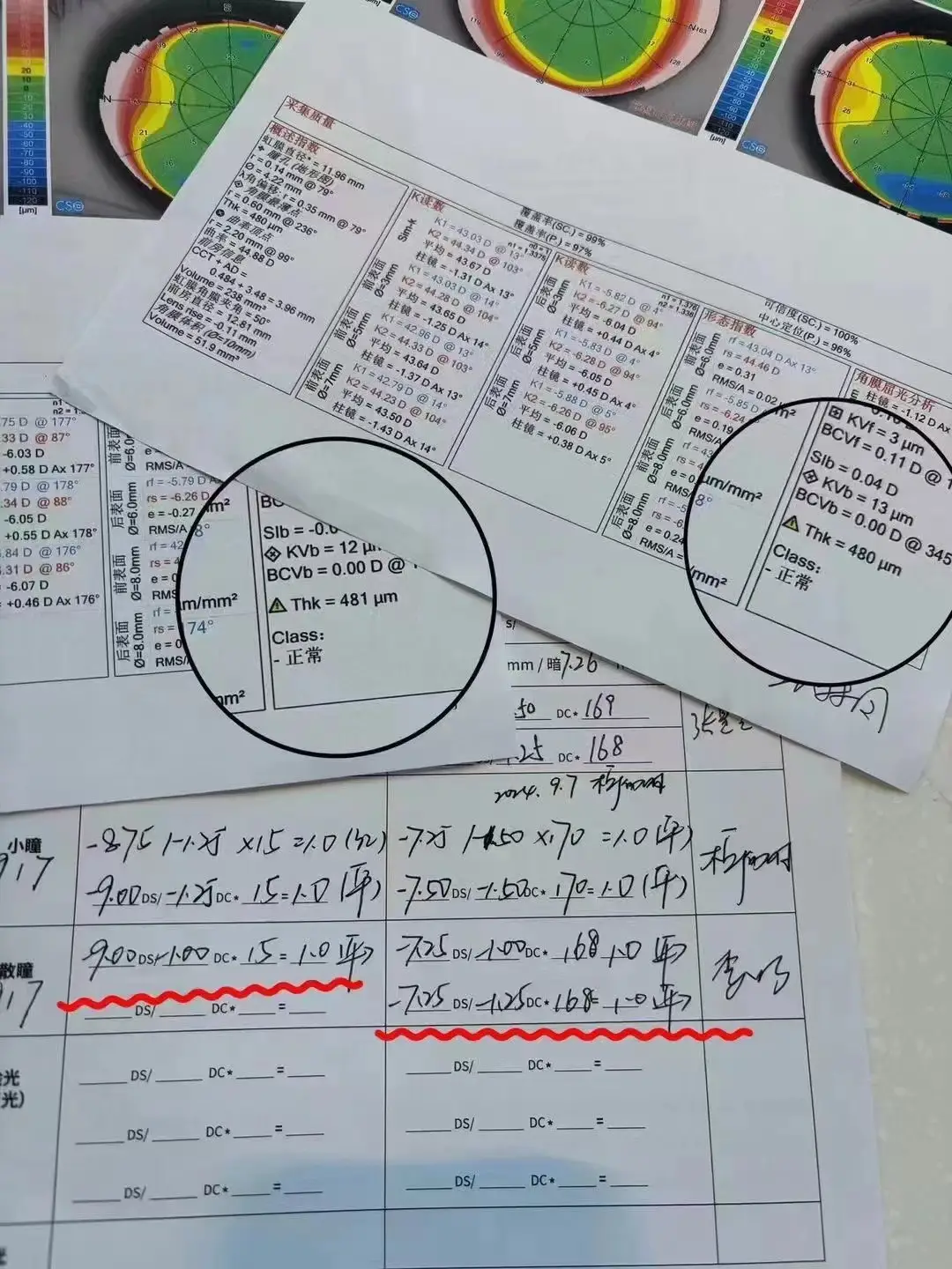 西安华厦医院近视手术：角膜厚度与手术效果的关键因素解析  第2张