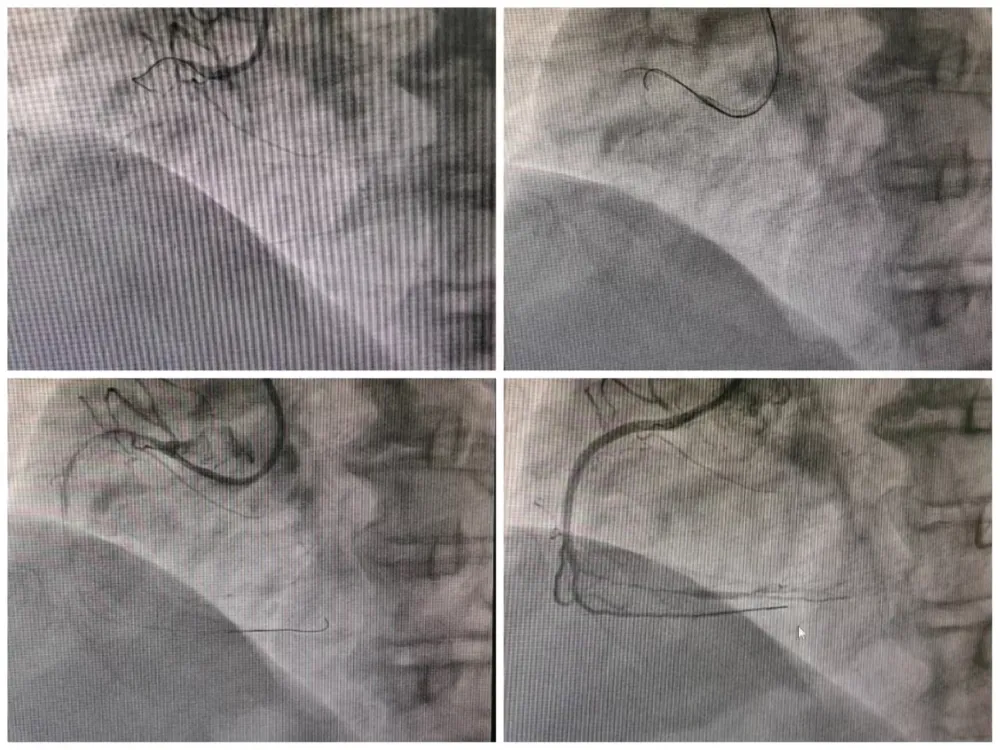 66岁冠心病患者2年6次冠脉造影成功挖通100%狭窄闭塞的右冠状动脉  第3张