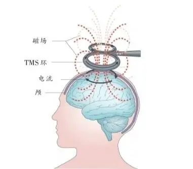 解密意识障碍：康复治疗与慢性意识障碍的分类与解析  第3张