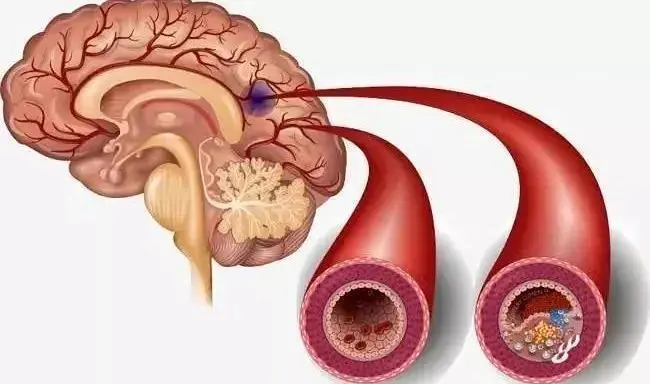 脑卒中：高发病率、高致残率和高死亡率的脑血管疾病  第5张