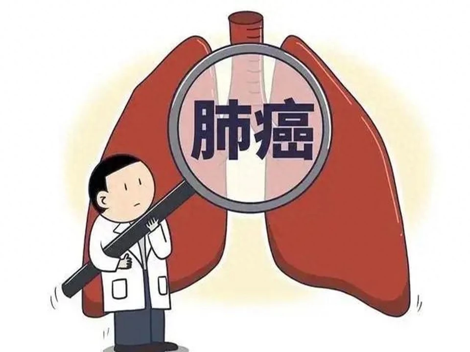 肺癌：癌症之王的高发病率与死亡率，严重威胁人类生命健康  第1张