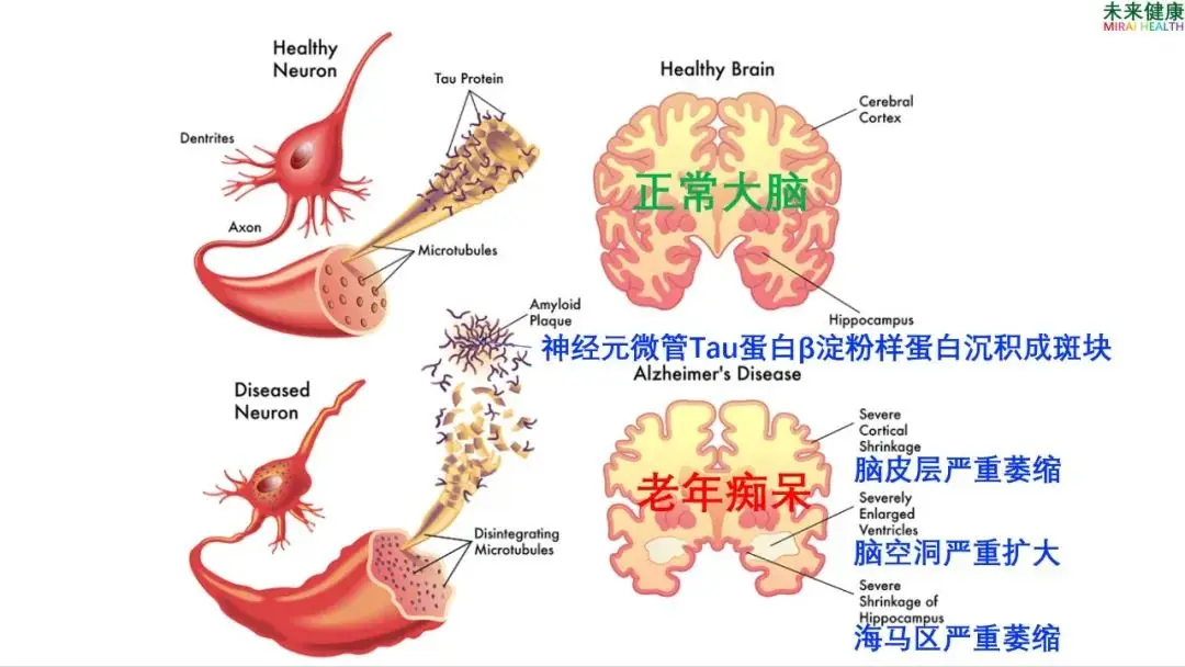 零热量甜饮料真的健康吗？阿斯巴甜神经毒害作用揭秘  第9张