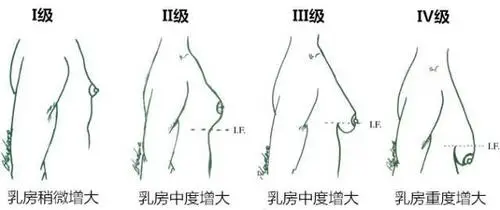 男性乳腺异常发育的原因及症状：激素失衡与触痛解析