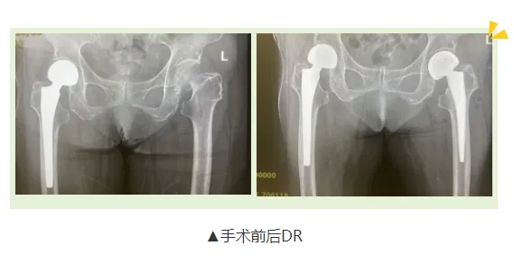 福清市100岁周奶奶摔倒后成功手术康复，高龄手术挑战与奇迹  第1张