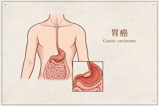 2022年中国胃癌新发病例35.87万人，死亡率高达26.04万，高发于60-74岁男性  第1张