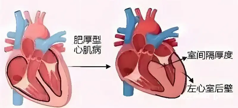 胸痛、呼吸困难、晕厥？小心肥厚型心肌病，专家建议家系筛查  第2张