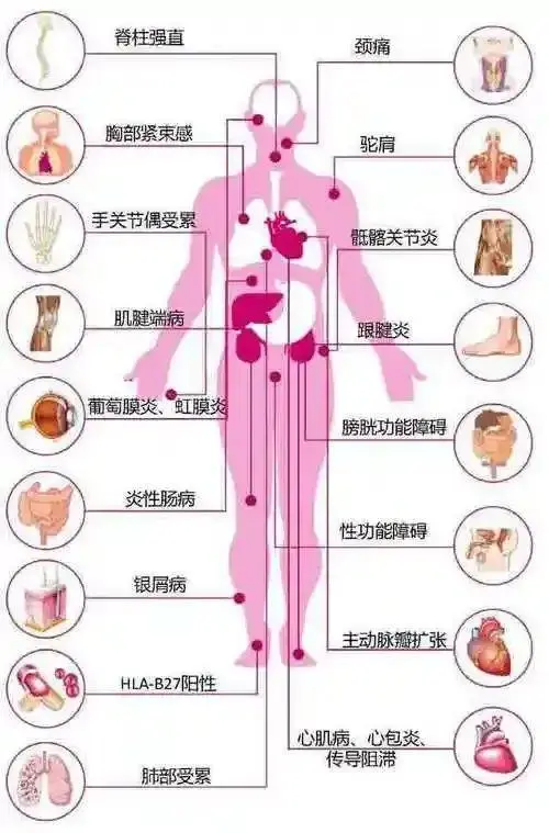 深入解析强直性脊柱炎：从症状到病理的全景描述及有效治疗策略  第2张