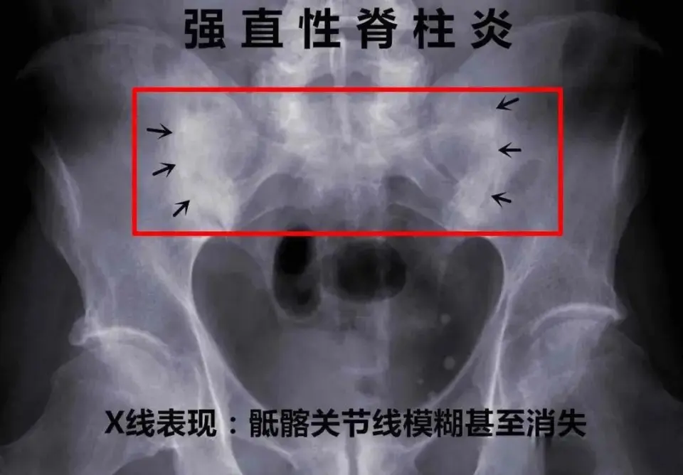 深入解析强直性脊柱炎：从症状到病理的全景描述及有效治疗策略  第4张