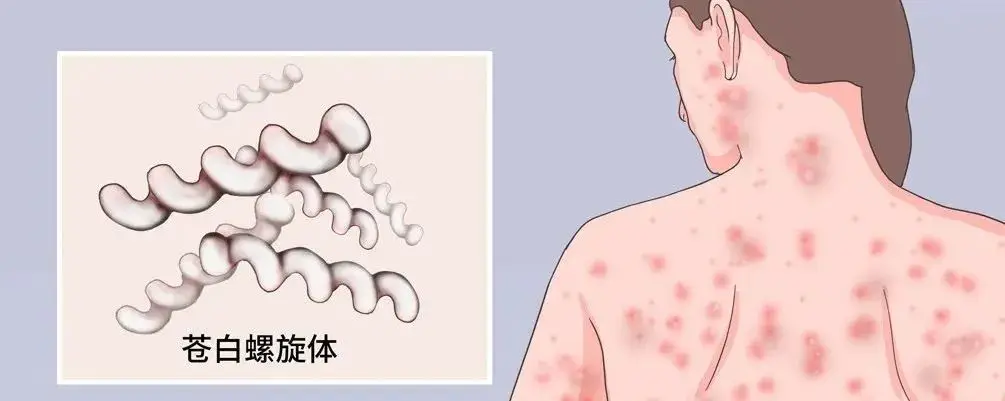梅毒传播途径及预防措施：性接触、母婴、血液传播详解  第1张