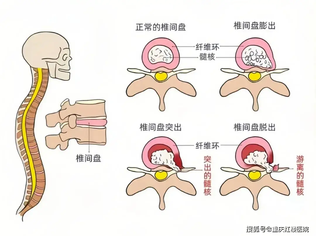 腰椎间盘突出症年轻化趋势及科学预防方法