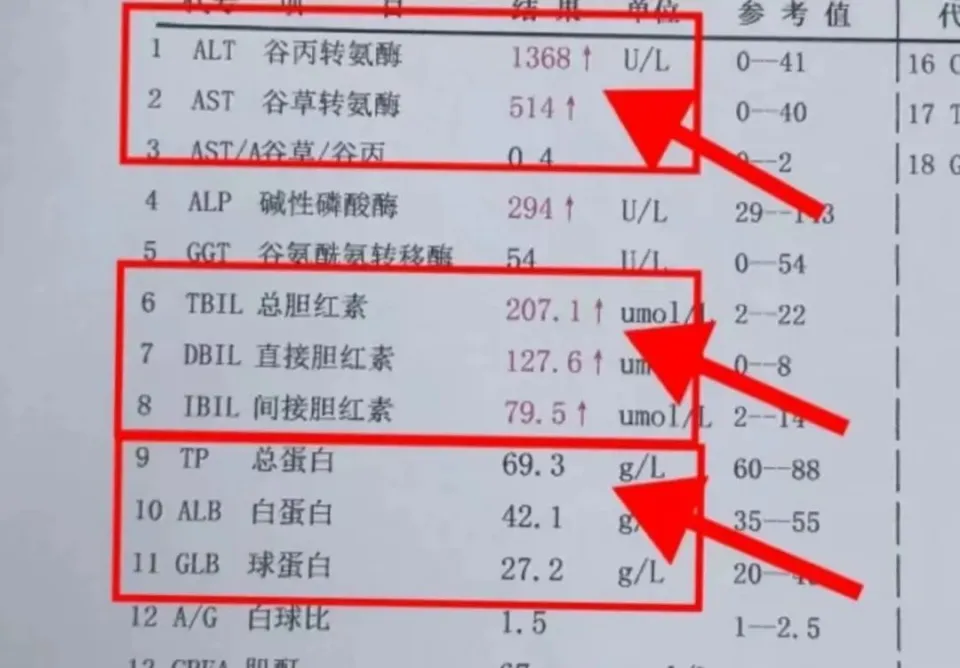 深入了解肝功能检查中的关键指标：转氨酶、胆红素和白蛋白  第3张