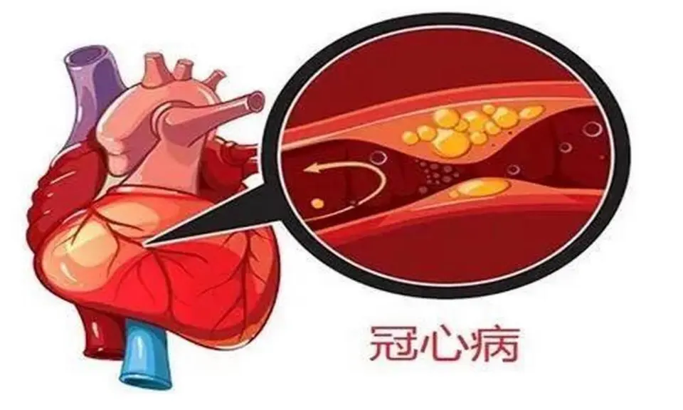 冠心病：心血管疾病的头号杀手，科学预防与治疗指南  第2张